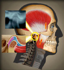 TMJ Oregon Image of Skull with Muscles reveled